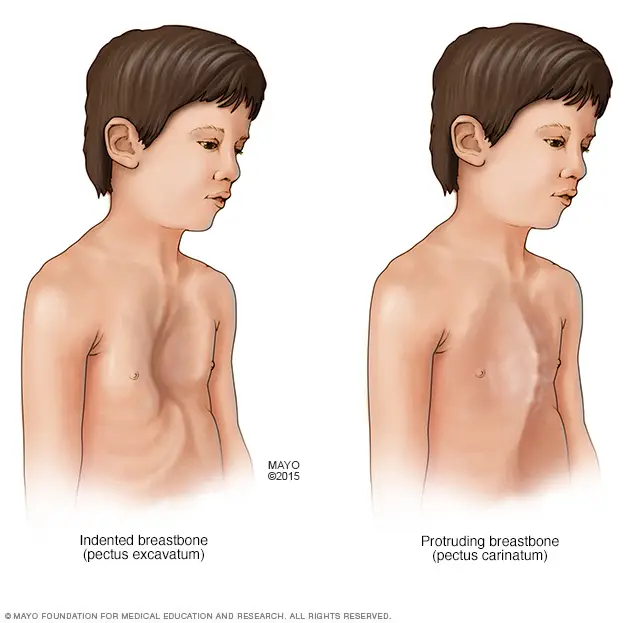 Tipos de Pectus