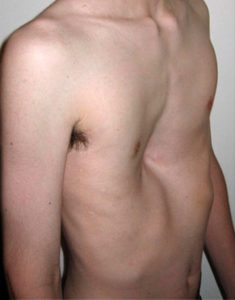 Cirurgia para Pectus Excavatum